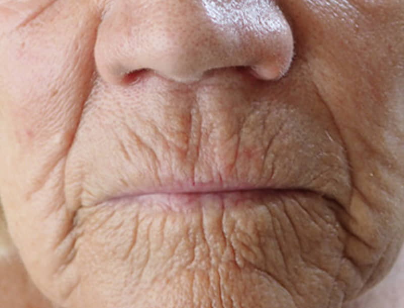 prístroj twotec anti-aging pred | premium aesthetic