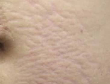 prístroj twotec ošetrujúci strie pred | premium aesthetic