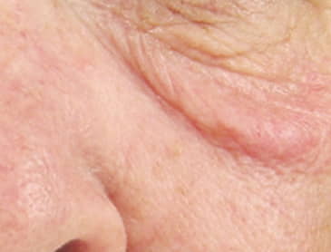 prístroj twotec ošetrujúci vačky pod očami pred | premium aesthetic
