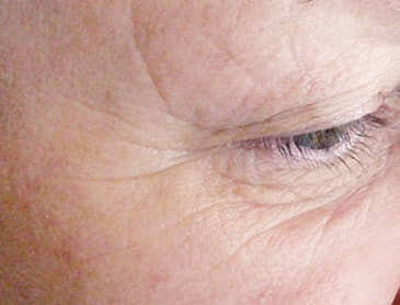 prístroj twotec ošetrujúci vrásky pred | premium aesthetic